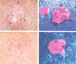 Heller Hautkrebs - auch Basalzellkarzinom - Darstellung durch eine Biopsie